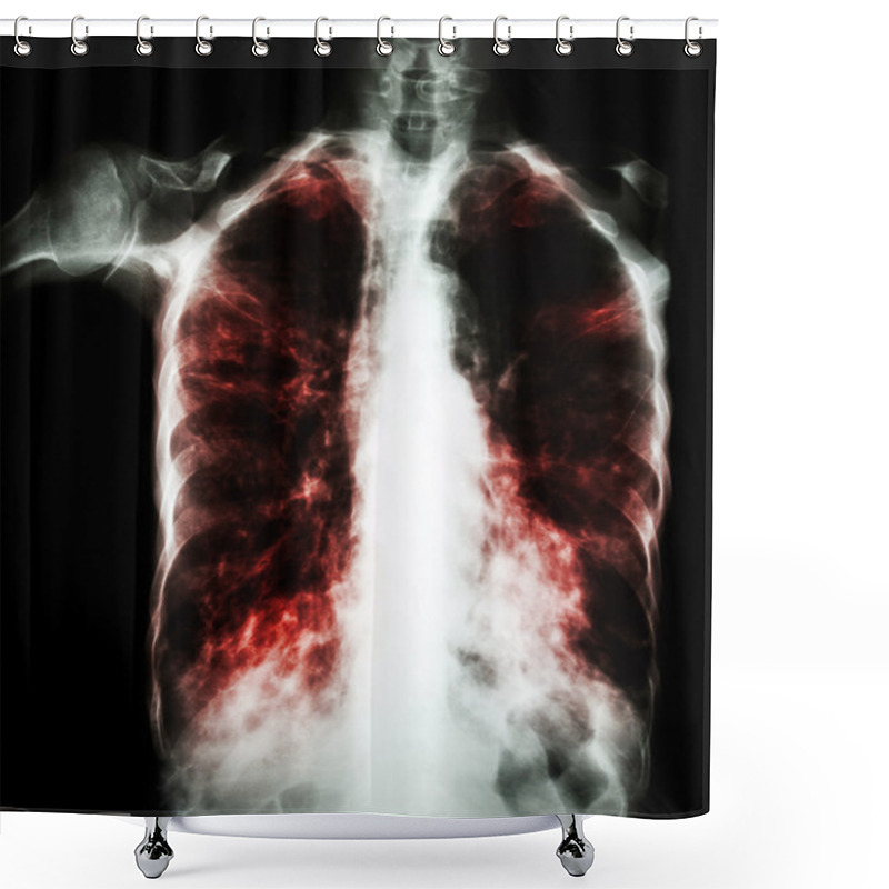 Personality  Pulmonary Tuberculosis  ( Film Chest X-ray :  Interstitial Infiltrate Both Lung Due To Mycobacterium Tuberculosis Infection ) Shower Curtains