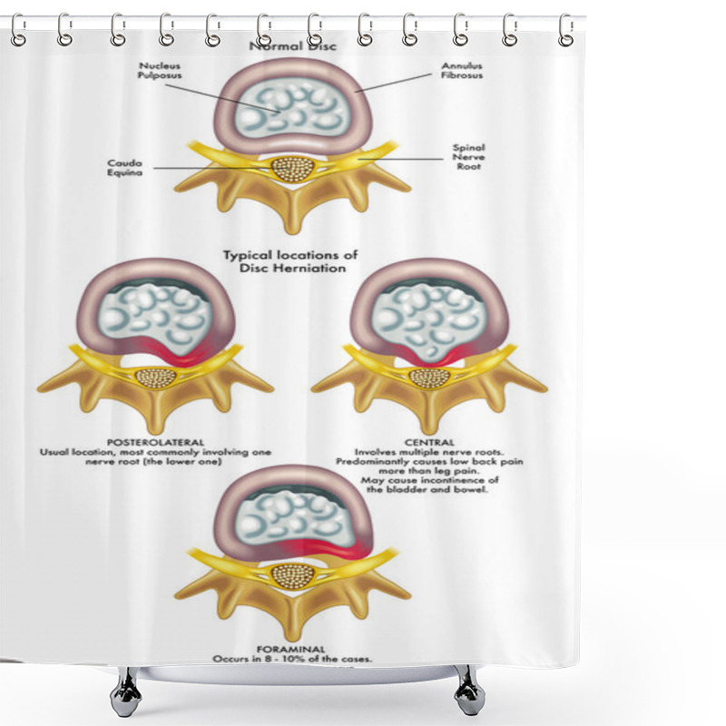 Personality  Injury To The Spinal Nerve Shower Curtains