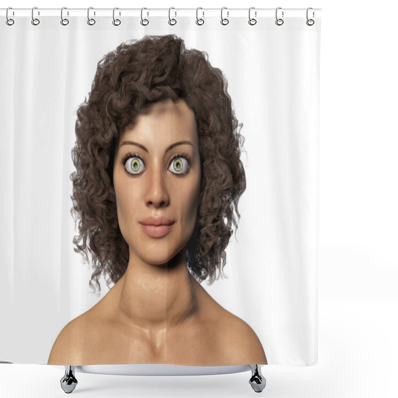 Personality  Hyperthyroidism. 3D Illustration Showing A Female With Graves' Disease, Also Known As Toxic Diffuse Goiter, Who Has Enlarged Thyroid Gland And Exophthalmos Shower Curtains