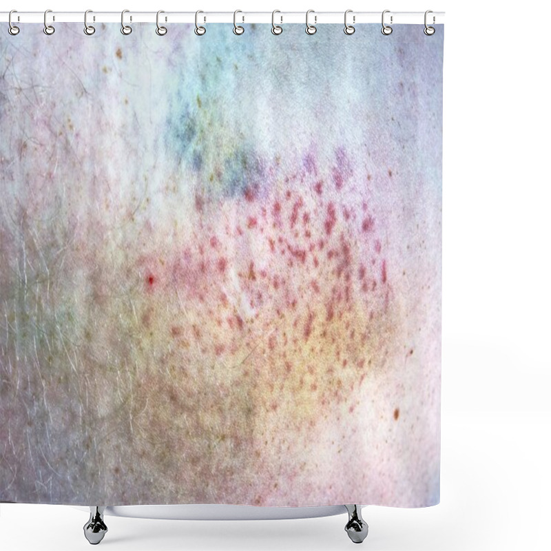 Personality  Large Bruise On Wounded Man Leg Skin Laying In Hospital Bed. Colorful Huge  Bruise On The Male Leg Shower Curtains