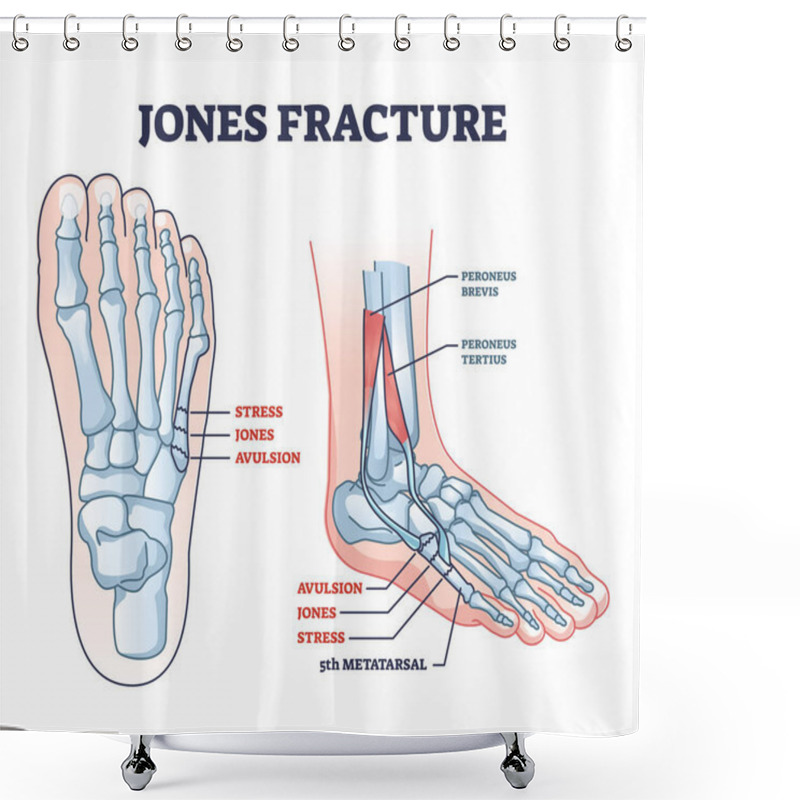 Personality  Jones Fracture And Foot Pinky Finger Bone Broken Damage Outline Diagram. Labeled Educational Scheme With Bone Stress Or Avulsion Sections Vetor Illustration. Peroneus Brevis And Tertius Muscle Anatomy Shower Curtains