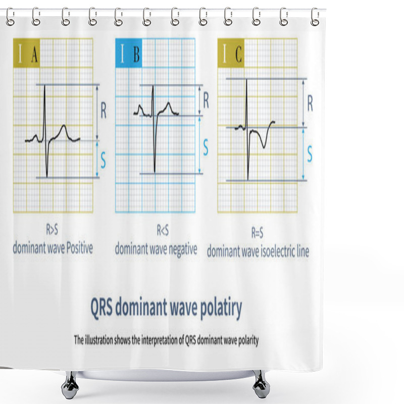 Personality  R Wave Greater Than S Wave Is Judged To Be Positive; R Smaller Than S  Is Judged To Be Negative; R Equal To S Amplitude Is Judged To Be Equipotential. Shower Curtains