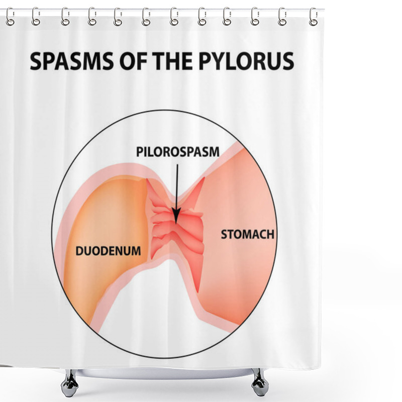 Personality  Spasms Of The Pylorus. Pylorospasm. Spastic And Atonic. Pyloric Sphincter Of The Stomach. Infographics. Vector Image On Isolated Background Shower Curtains