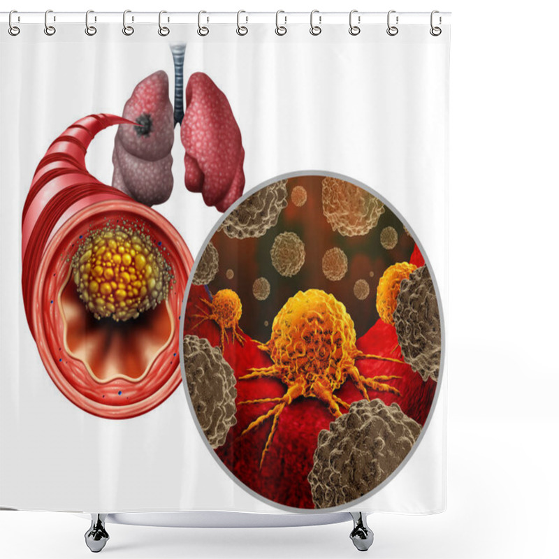 Personality  Small Cell Lung Cancer As A Central Malignant Tumor Growth As A Metastasis Growing In The Lungs From A Bronchi As A Bronchial Disease Spreading In The Human Body. Shower Curtains