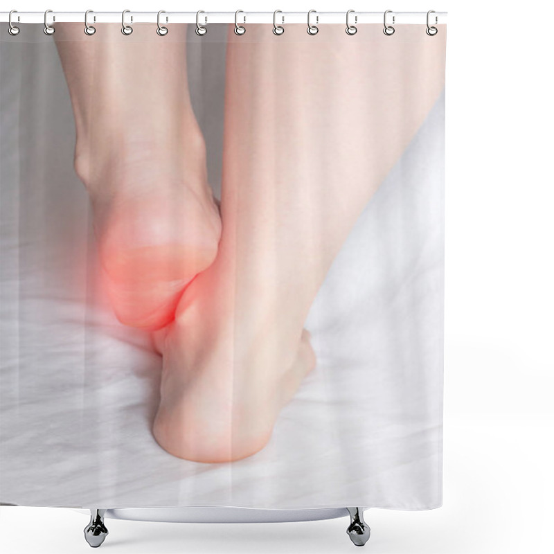 Personality  Female Legs On A White Background That Are Infected With Fungal Infection And Onychomycosis, Close-up, Medical, Mycosis Shower Curtains