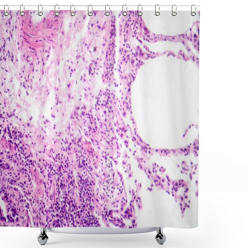 Personality  Photomicrograph Of Interstitial Pneumonia, Showing Inflammation And Fibrosis In The Lung's Interstitial Tissue. Shower Curtains