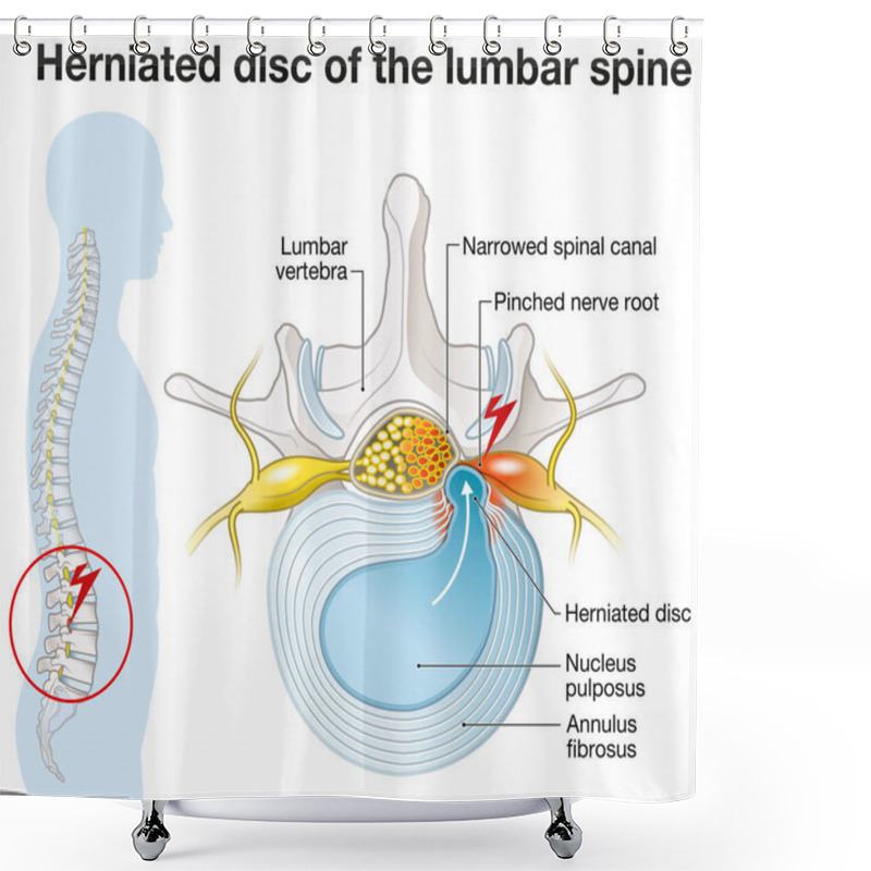 Personality  Illustration Showing Lumbar Vertebra With Intervertebral Disc And Herniated Nucleus Pulposus Shower Curtains