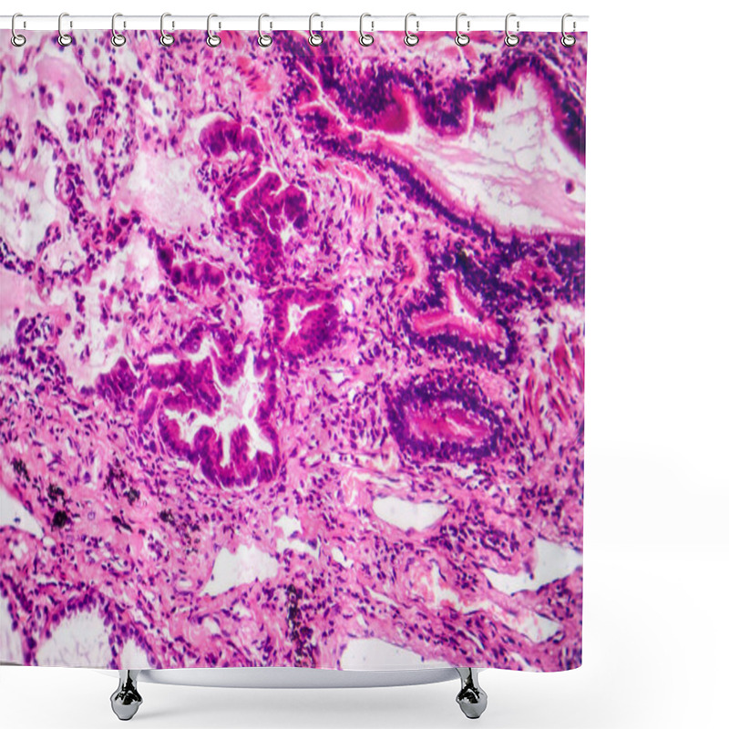 Personality  Photomicrograph Of Lung Adenocarcinoma, Displaying Malignant Glandular Cells Indicative Of The Most Common Type Of Lung Cancer. Shower Curtains