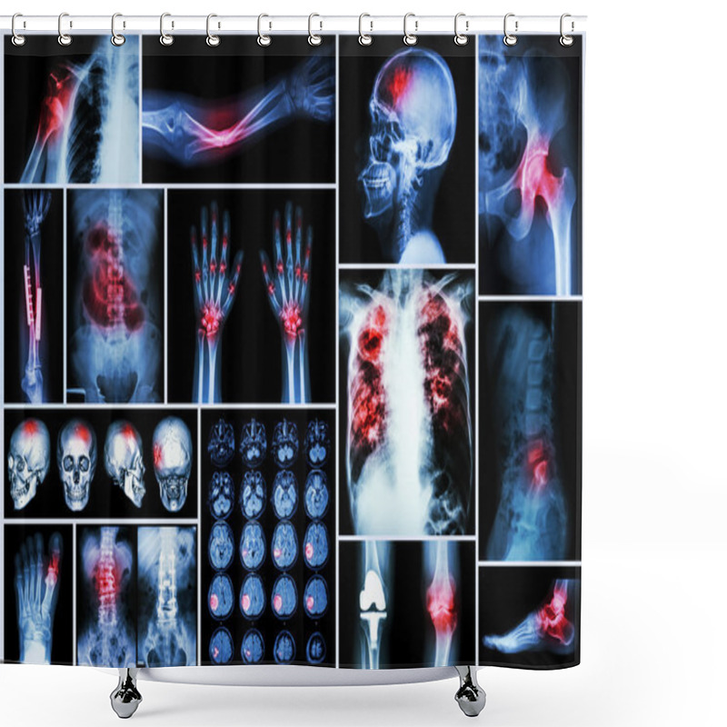 Personality  X-ray Multiple Disease (Stroke (cerebrovascular Accident) : Cva ,Pulmonary Tuberculosis ,Bone Fracture ,Shoulder Dislocation ,Gout ,Rheumatoid Arthritis ,Spondylosis ,Osteoarthritis ,Bowel Obstruction Shower Curtains