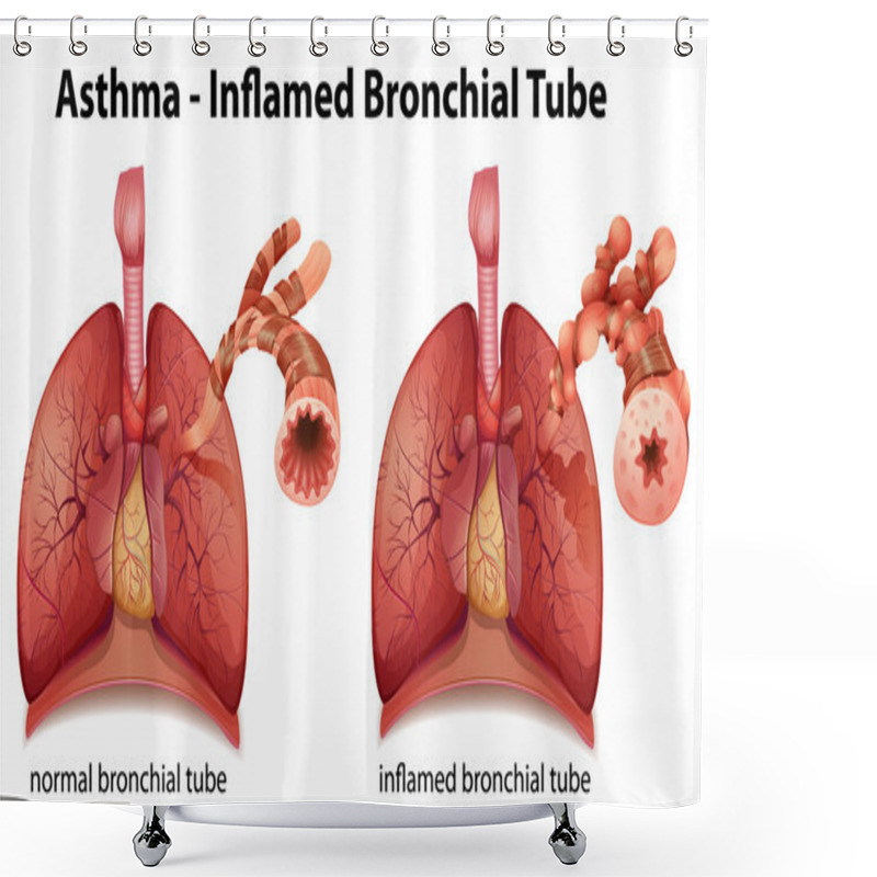 Personality  Asthma Shower Curtains