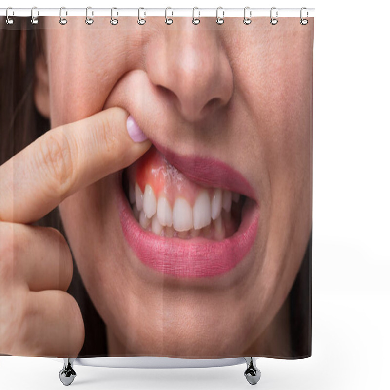 Personality  Close-up Of A Woman's Finger Showing Swelling Of Her Gum Shower Curtains