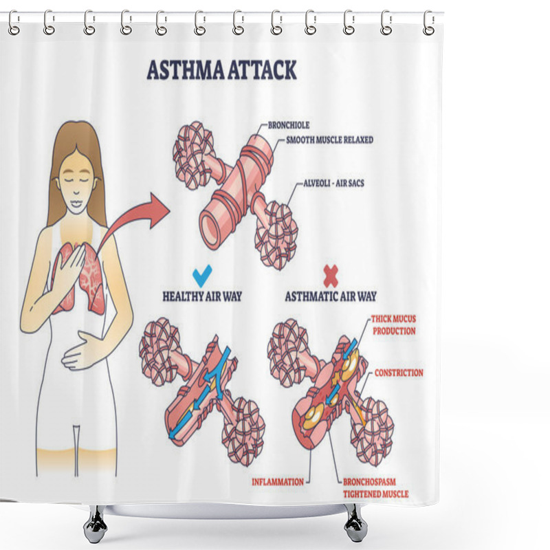 Personality  Asthma Attack Explanation Compared With Healthy Air Way Outline Diagram. Labeled Educational Scheme With Mucus Production And Inflammation In Lungs Vector Illustration. Anatomical Respiration System. Shower Curtains