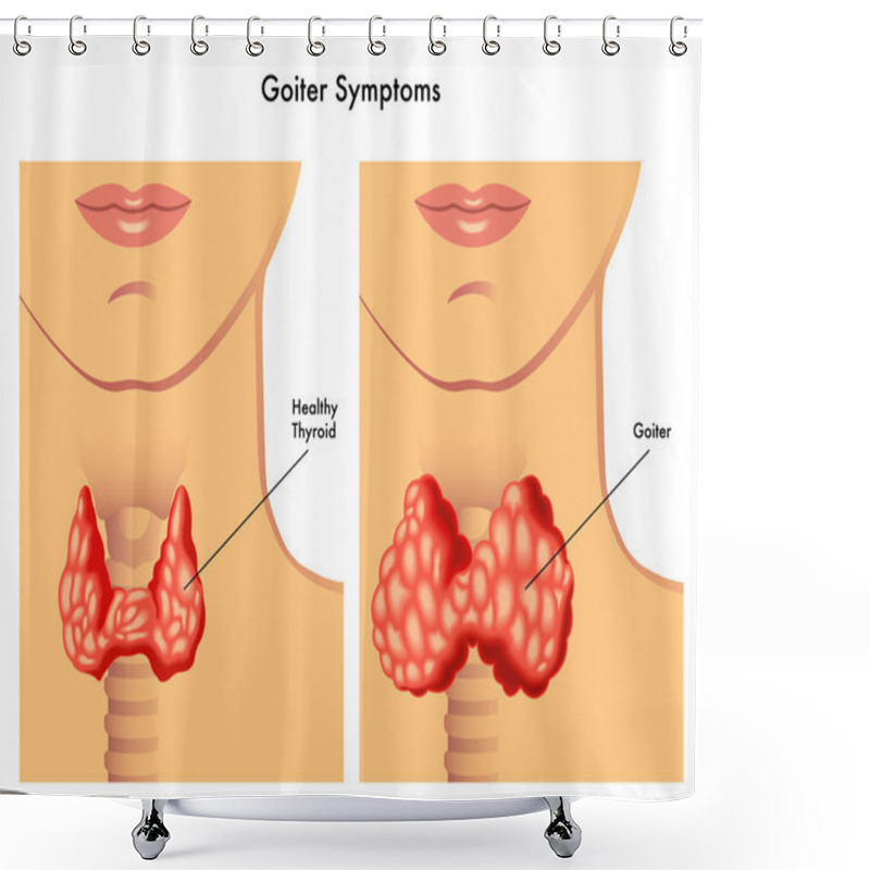 Personality  Detailed Human Goiter Shower Curtains