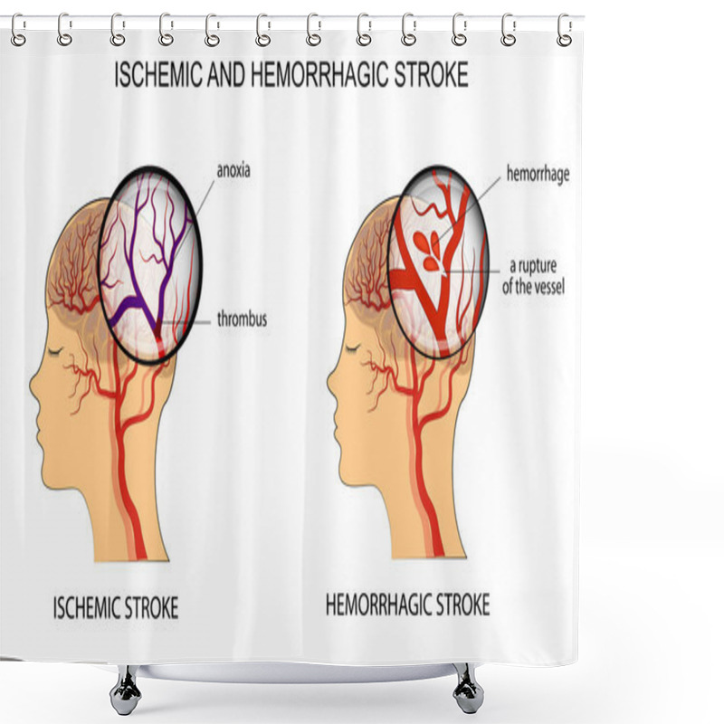 Personality  ISCHEMIC AND HEMORRHAGIC STROKE Shower Curtains