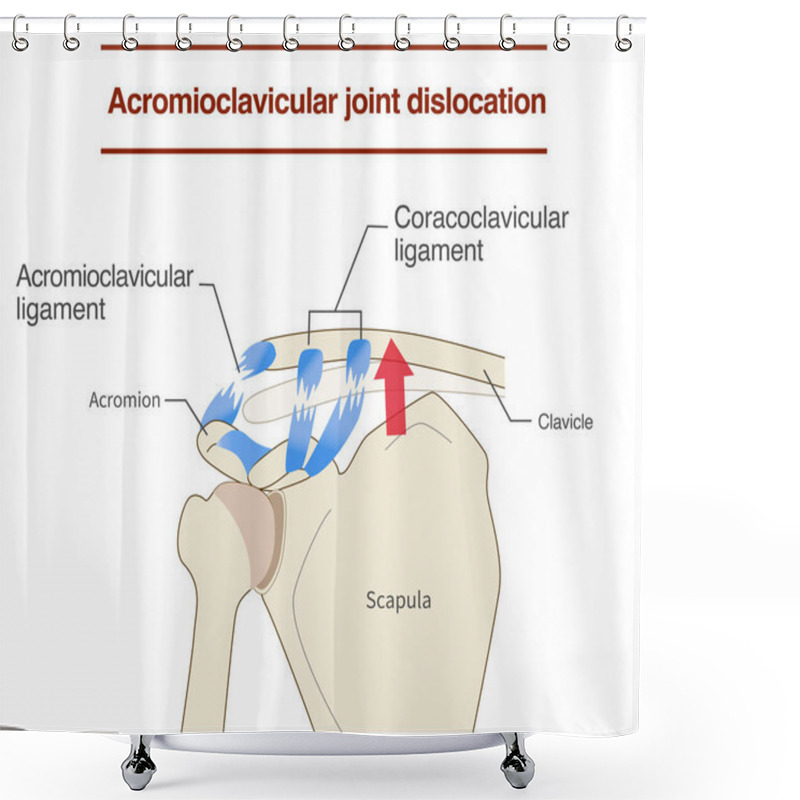 Personality  Dislocation Of The Acromioclavicular Joint And Ligaments And Its Mechanism Shower Curtains