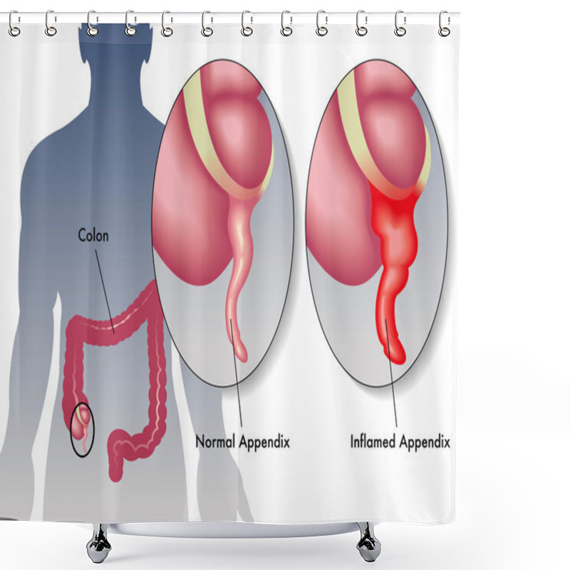 Personality  Detail Of An Appendicitis Shower Curtains