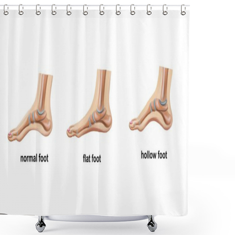 Personality  Illustration Of The Normal Foot, Flat Foot And Hollow Foot Shower Curtains