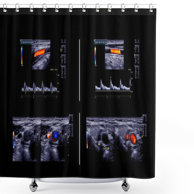 Personality  Ultrasound Doppler For Finding  Deep Vein Thrombosis. Shower Curtains