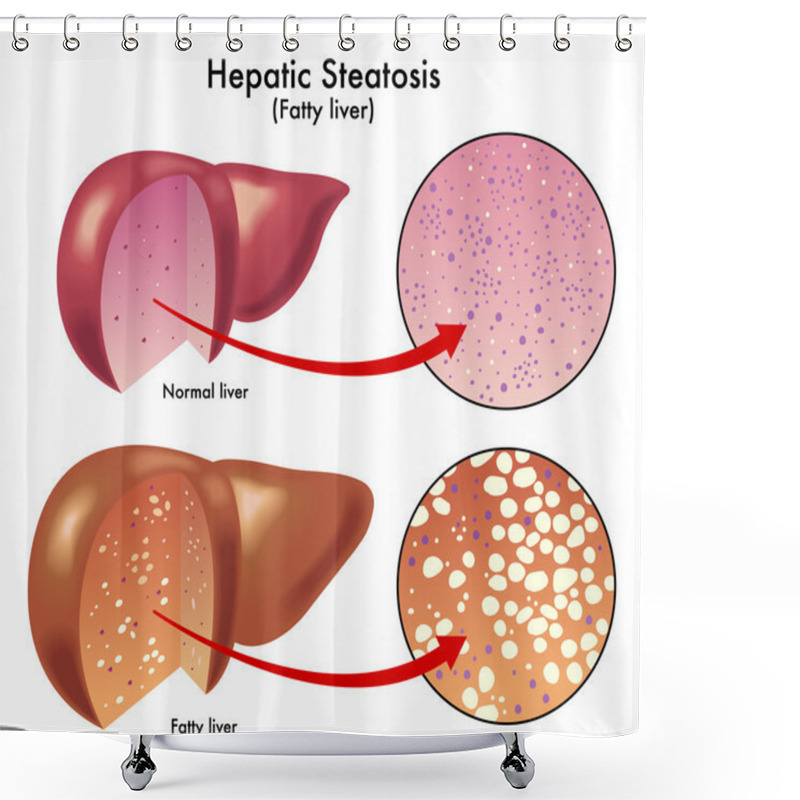 Personality  Hepatic Steatosis Shower Curtains