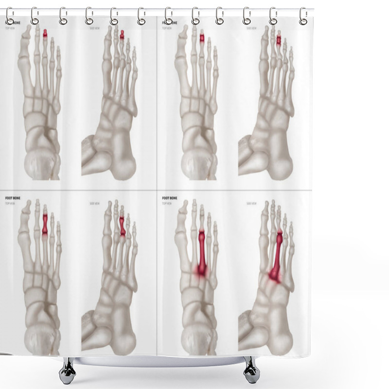 Personality  X-ray Collection Of Middle Toe Foot Bone With Red Highlights On Different Pain And Joint Area-top And Side View-Healthcare-Human Anatomy And Medical Concept-Isolated On White Background. Shower Curtains