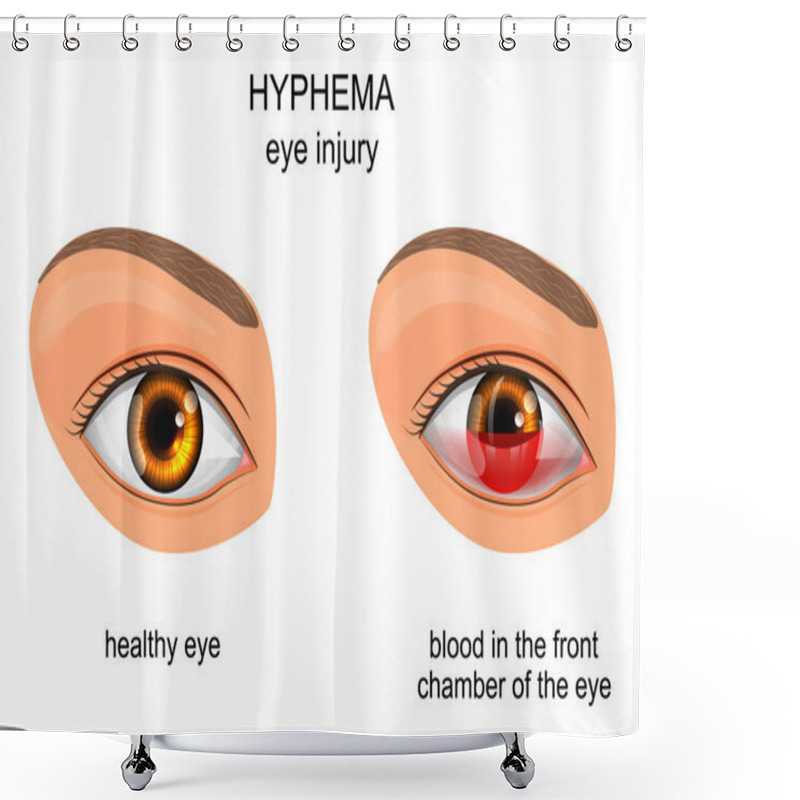 Personality  Trauma To The Eye. Hyphema. Shower Curtains