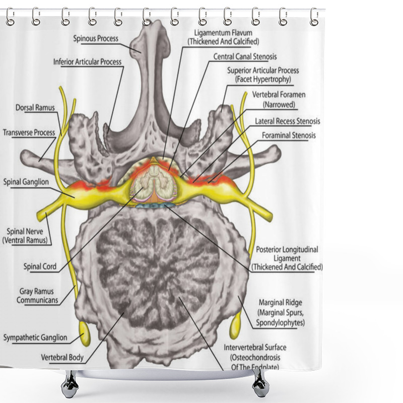 Personality  Central Lateral Stenosis, Second Lumbar Vertebra, Nervous System, Spinal Cord, Lumbar Spine, Nerve Root, Advanced Uncovertebral Arthrosis Of The Lumbar Vertebra, Degenerative Changes Vertebra, Osteophytes, Spondylophytes, Osteoarthritis Of The Joints Shower Curtains