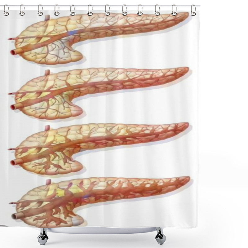 Personality  Evolution Of The Lesion Of The Pancreatic Duct. Shower Curtains