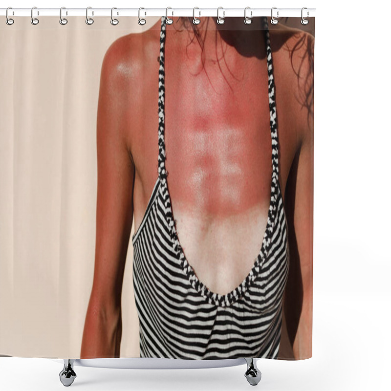 Personality  Woman Body Hurt Sun Burn Shower Curtains