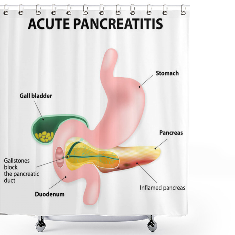 Personality  Acute Pancreatitis Shower Curtains