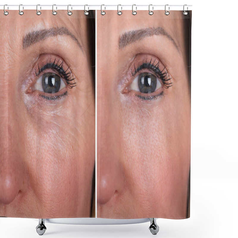 Personality  Photo Of Anti-aging Procedures On Caucasian Woman Face Shower Curtains