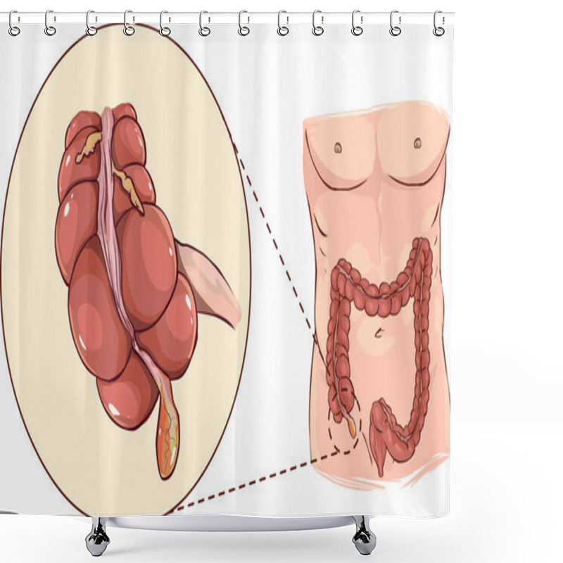 Personality  With Detail Of An Appendicitis Shower Curtains