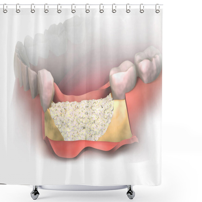 Personality  Adding New Bone To Bone Loss On Lower Jaw After Tooth Removal.  Bone Grafting Placement In Front View. Before Putting Membrane On Bone Graft. 3D Illustration. Dental Augmentation Surgery. Shower Curtains