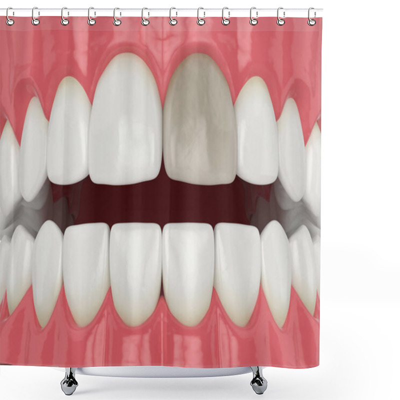 Personality  3d Render Of Jaw And Upper Incisor Tooth With Dead Pulp Shower Curtains