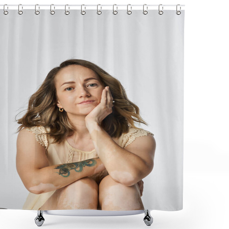 Personality  A Young Woman With Vitiligo Sits Gracefully, Resting Her Chin On Her Hand, Exuding Beauty. Shower Curtains