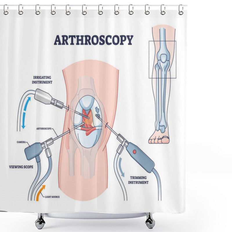 Personality  Arthroscopy Procedure As Knee Diagnostics Process Explanation Outline Diagram Shower Curtains