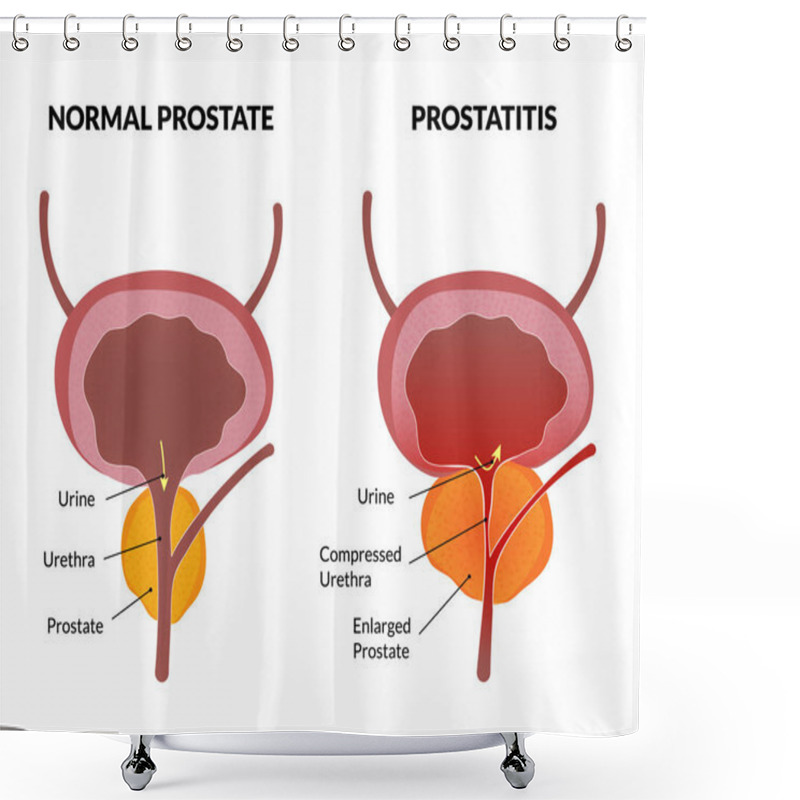 Personality  Prostatitis Pathology Poster Shower Curtains