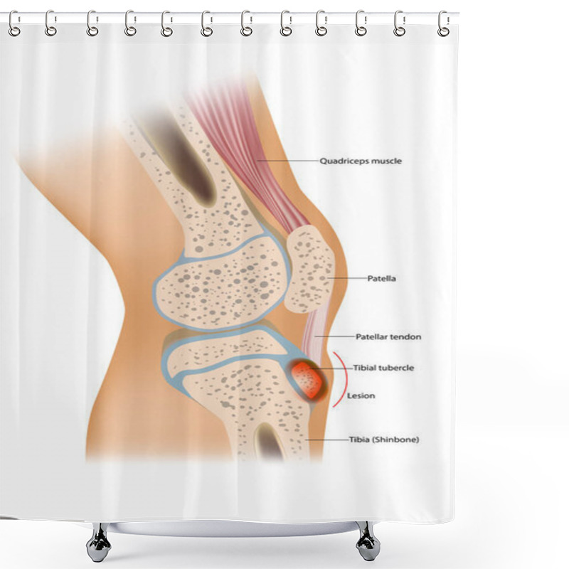 Personality  Osgood Schlatter Disease Or OSD Is Inflammation Of The Patellar Ligament At The Tibial Tuberosity Shower Curtains