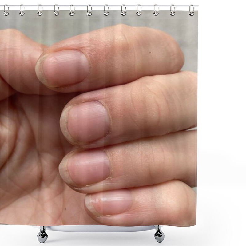 Personality  Unusual Shrunken Missing Lunula Half Moon On Nails Which Is Symptom Of Anaemia, Malnutrition, Kidney Disease Or Other. With Unhealthy Proximal Fold ,cuticle  Shower Curtains