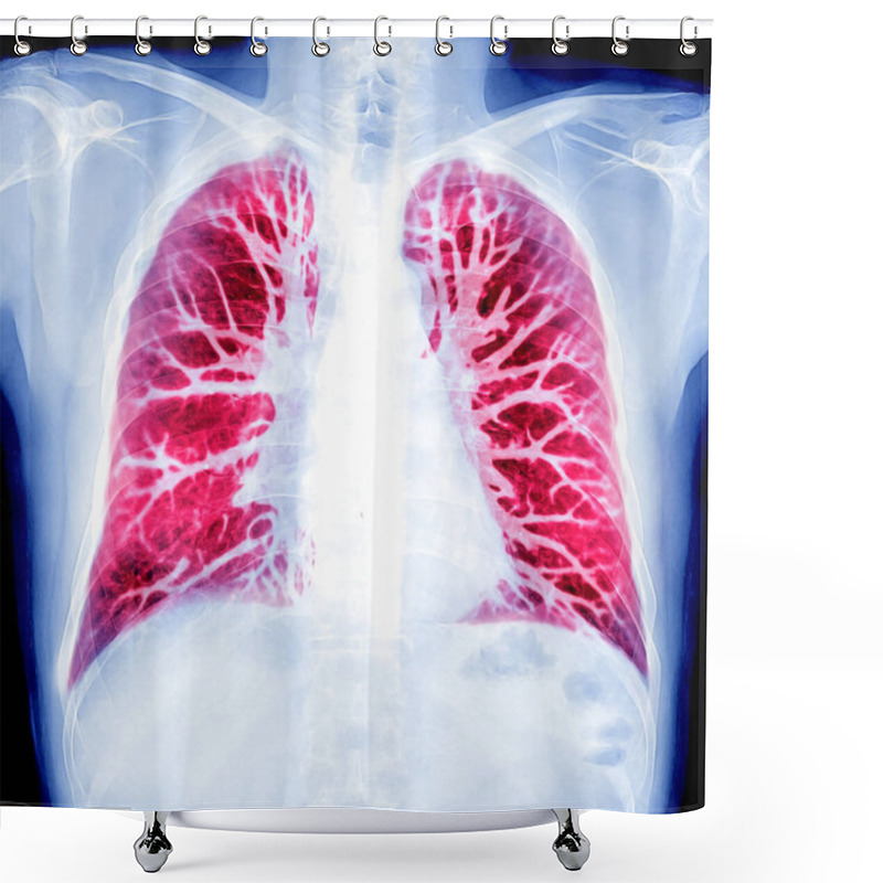 Personality  Oil Paint Effect  Of Chest X-ray Or X-Ray Image And CT Chest Lung Preset For Detected  Tuberculosis Shower Curtains