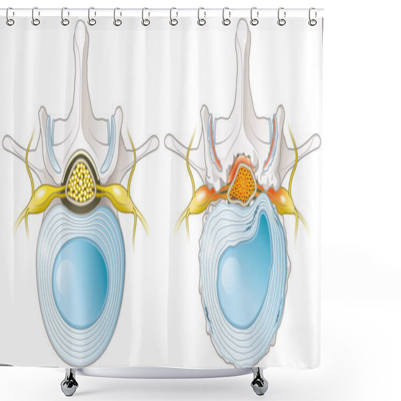 Personality  Illustration Showing Spinal Canal Stenosis Lumbar Vertebra With Intervertebral Disc And Herniated Nucleus Pulposus Shower Curtains