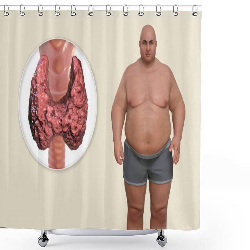 Personality  Association Between Autoimmune Thyroid Disease And Obesity, Conceptual 3D Illustration Showing An Overweight Patient And Thyroid Gland Attacked By Antibodies Shower Curtains