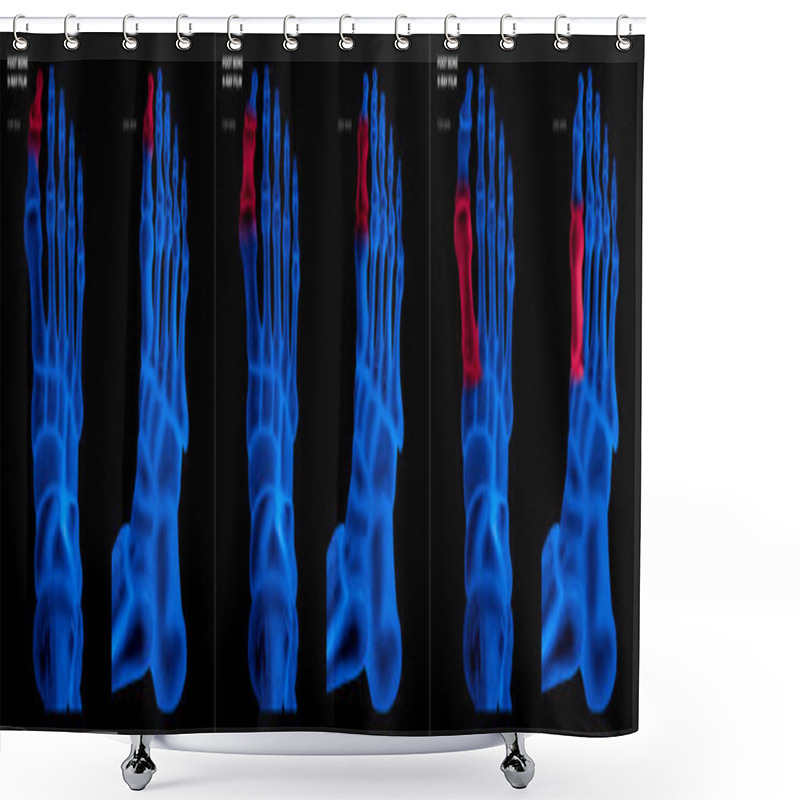 Personality  X-ray Blue Film Collection Of Big Toe Foot Bone With Red Highlights On Different Pain And Joint Area-top And Side View-Healthcare-Human Anatomy And Medical Concept-Isolated On Black Background. Shower Curtains