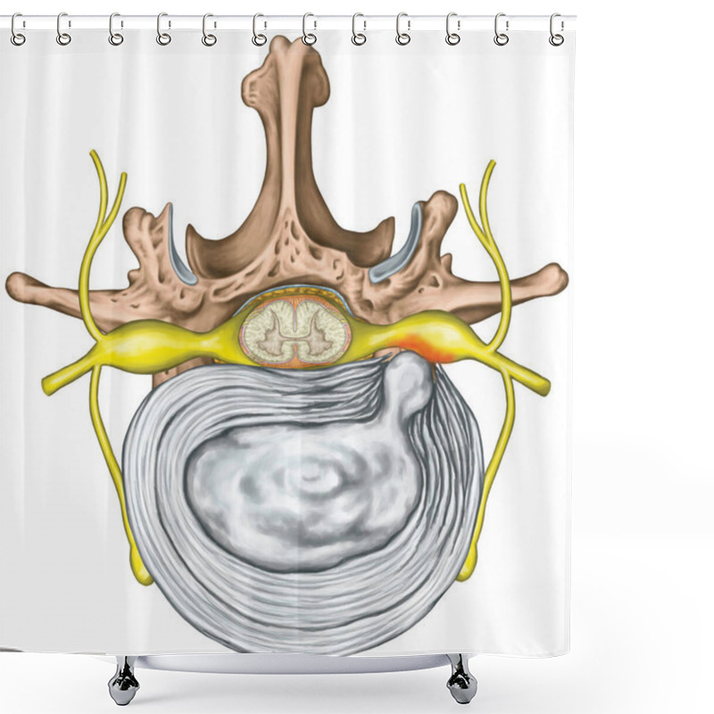 Personality  Lumbar Disk Herniation, Herniated Disc, Lumbar Vertebra, Lumbar Spine, Intervertebral Disk, Nervous System, Nerve Root, Spinal Cord, Vertebra, Anatomy Of Human Skeletal And Nervous System, Superior View Shower Curtains