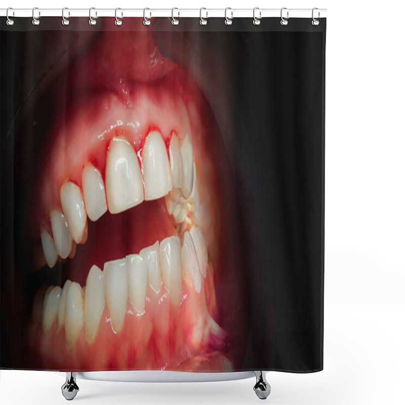 Personality  Mouth With Bleeding Gums On A Dark Background. Shower Curtains