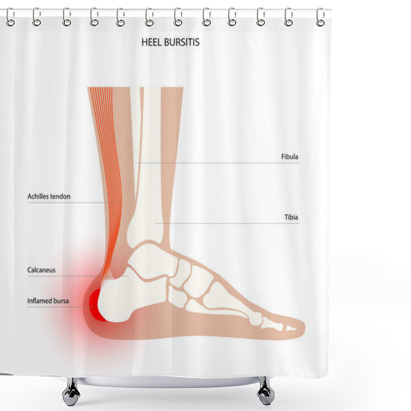 Personality  Bursitis Inflammation Concept Shower Curtains