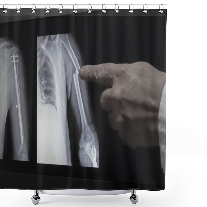 Personality  On The Monitor Screen Is Displayed An Xray Of Fracture Of A Hand With The Hand Of A Doctor Pointing To A Fracture. The Second Image On The Screen Is Hand After Operation With Titanium Screws. Shower Curtains