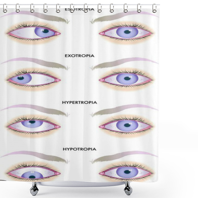 Personality  Medical Illustration Of The Effects Of The Strabismus Shower Curtains