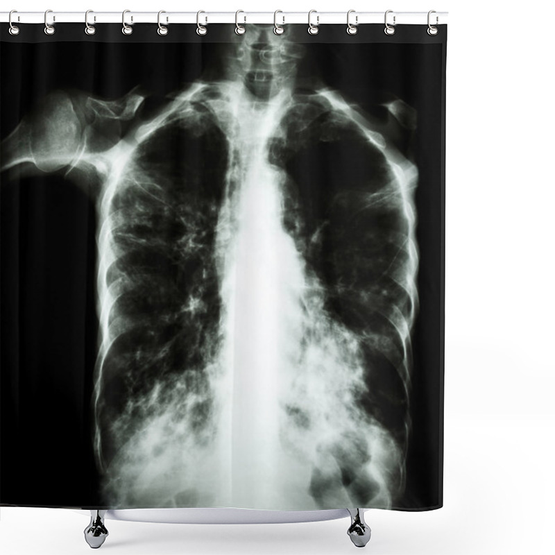 Personality  Pulmonary Tuberculosis  ( Film Chest X-ray :  Interstitial Infiltrate Both Lung Due To Mycobacterium Tuberculosis Infection ) Shower Curtains