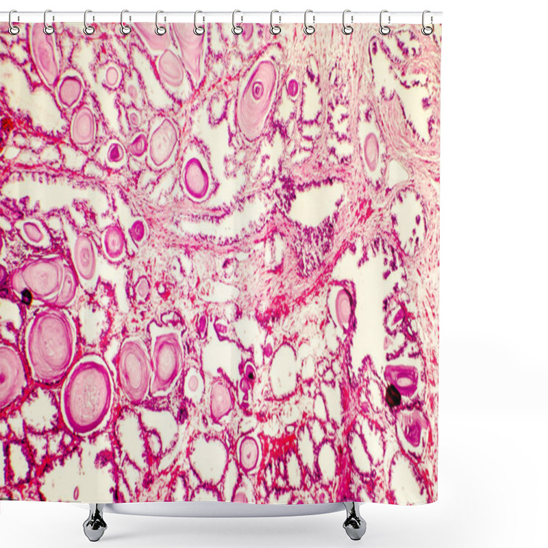 Personality  Photomicrograph Of Prostate Hyperplasia Shower Curtains