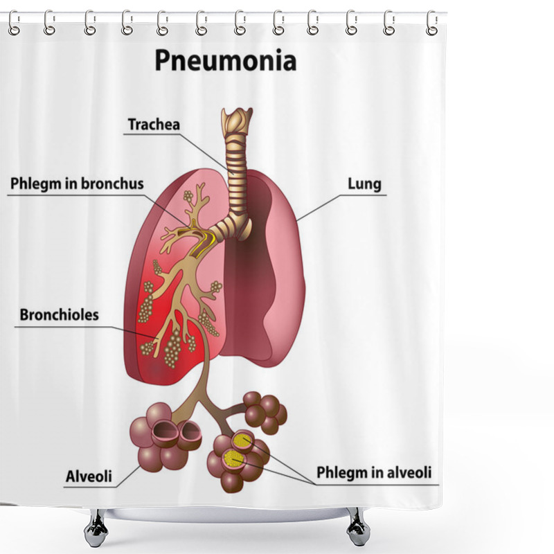 Personality  Pneumonia Shower Curtains